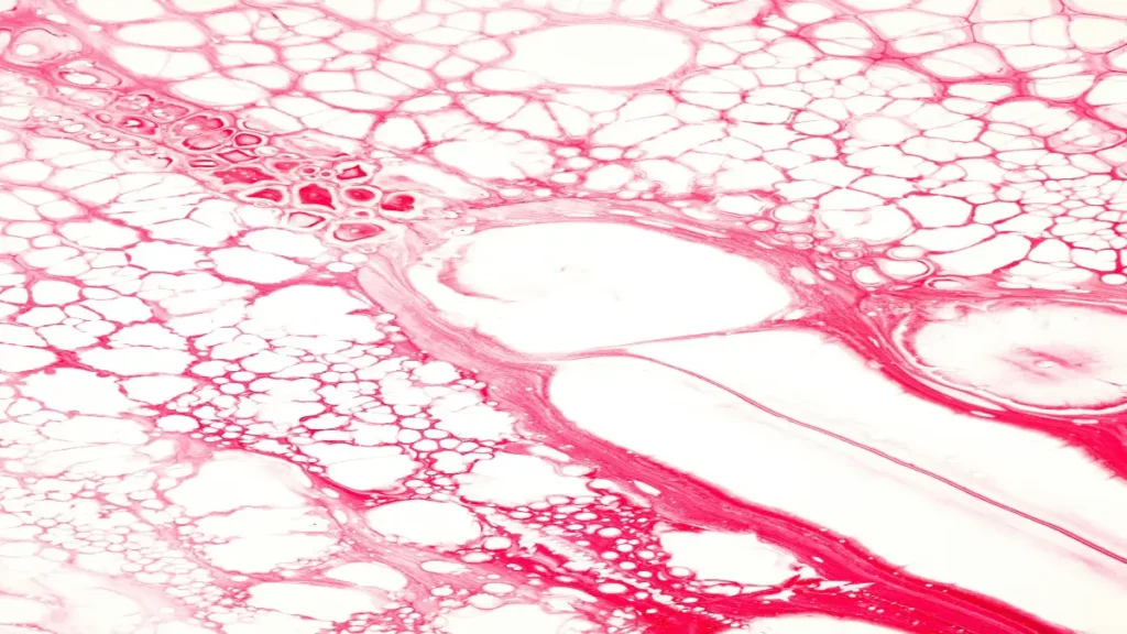 Symptoms of Sickle Cell Disease